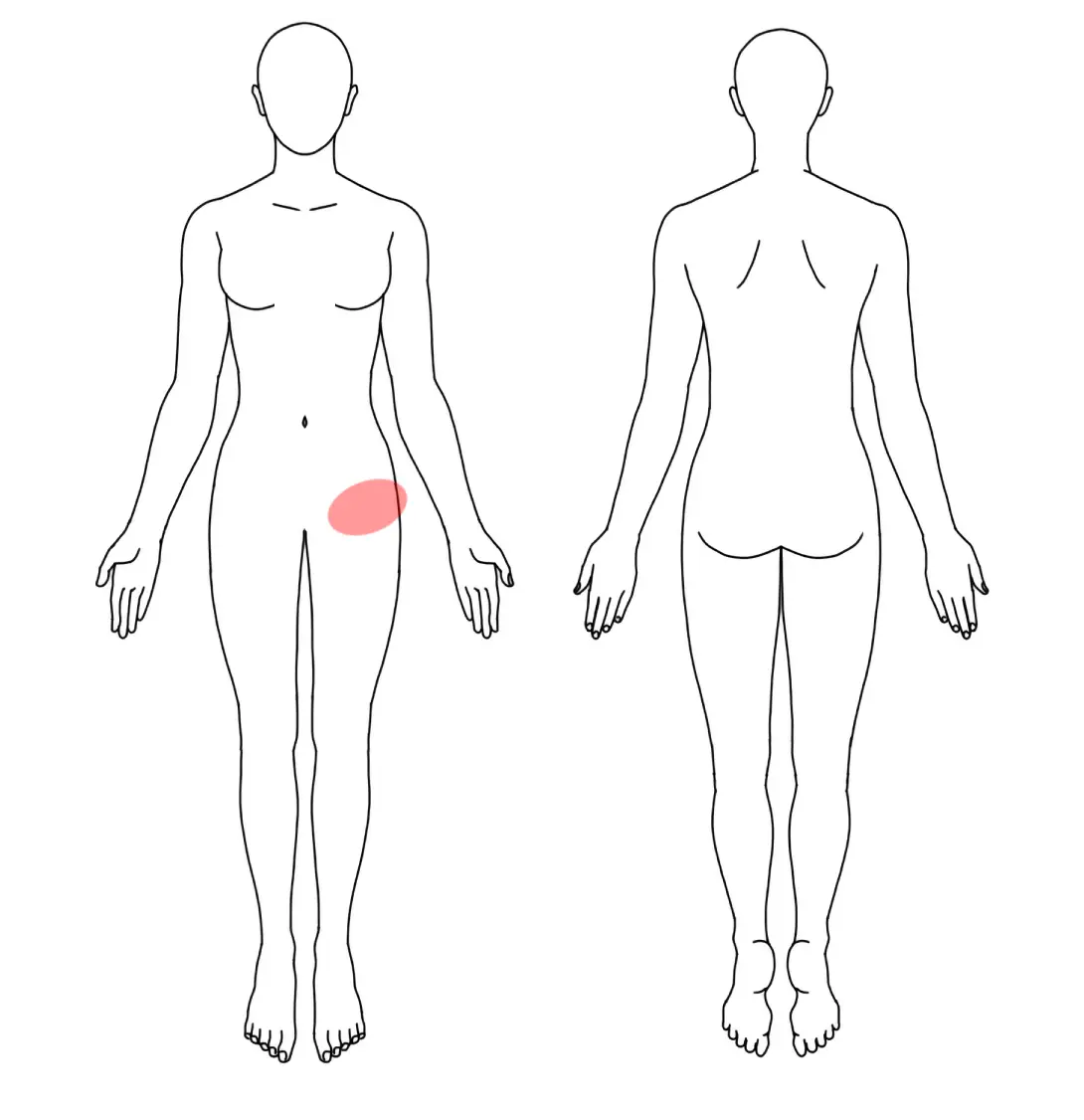 人体図（Ｈさんの左の鼠径部痛）