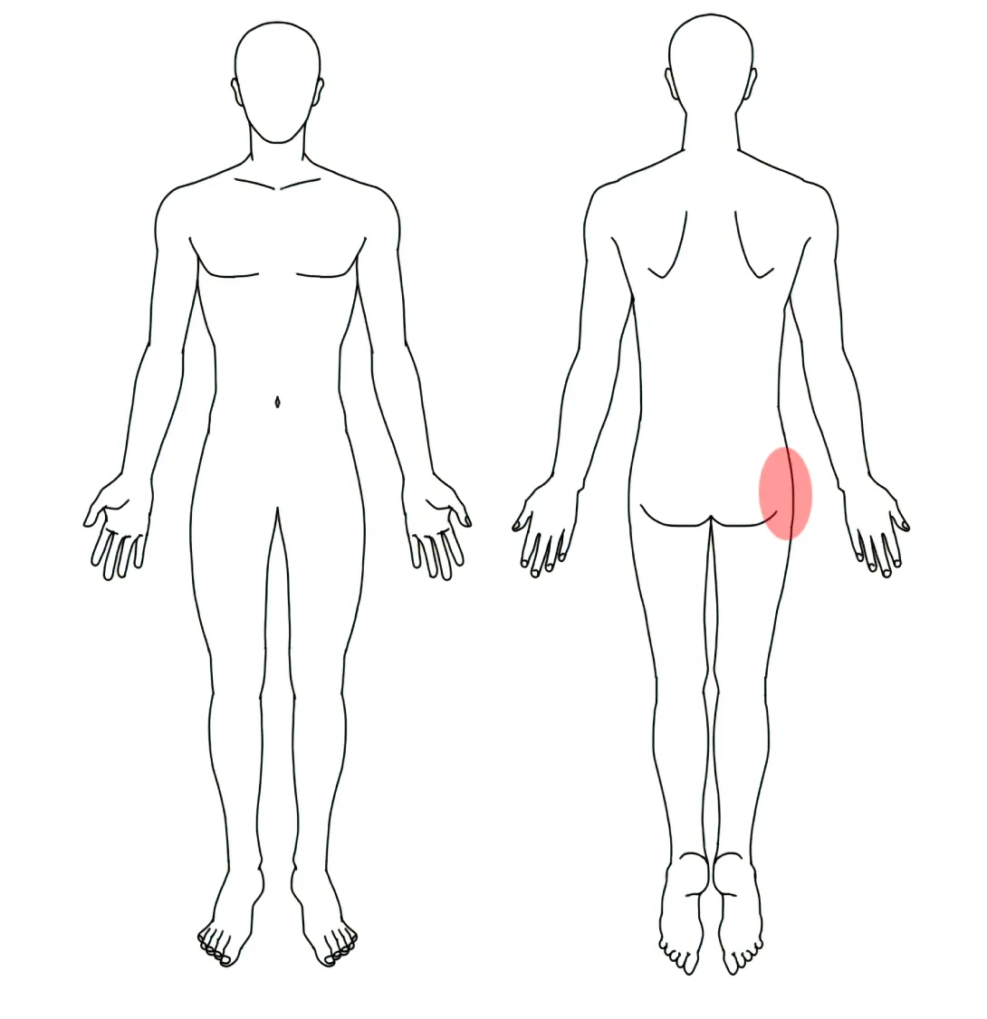 人体図（Ａさんの右の股関節痛）
