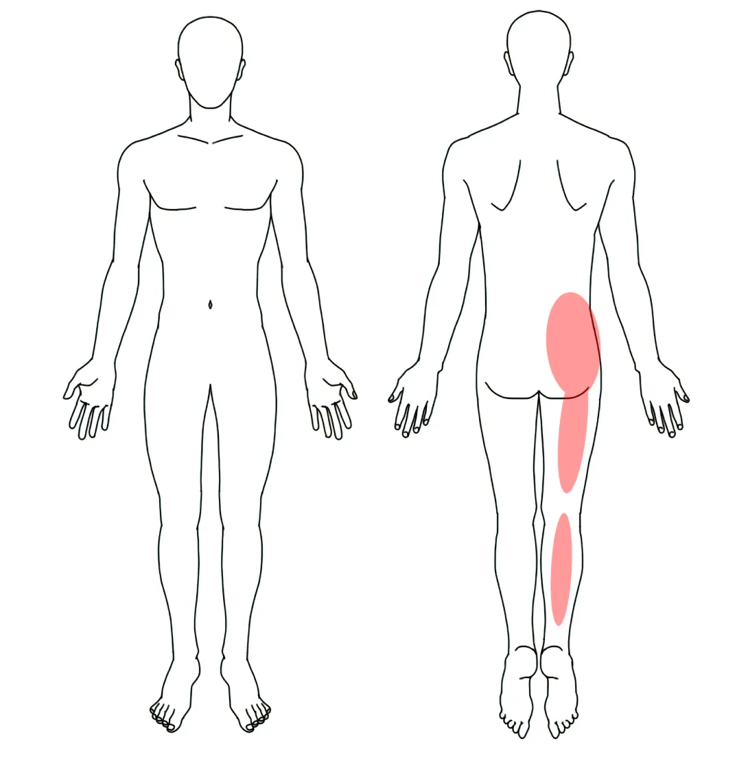 人体図（Ｙさんの右の坐骨神経痛）