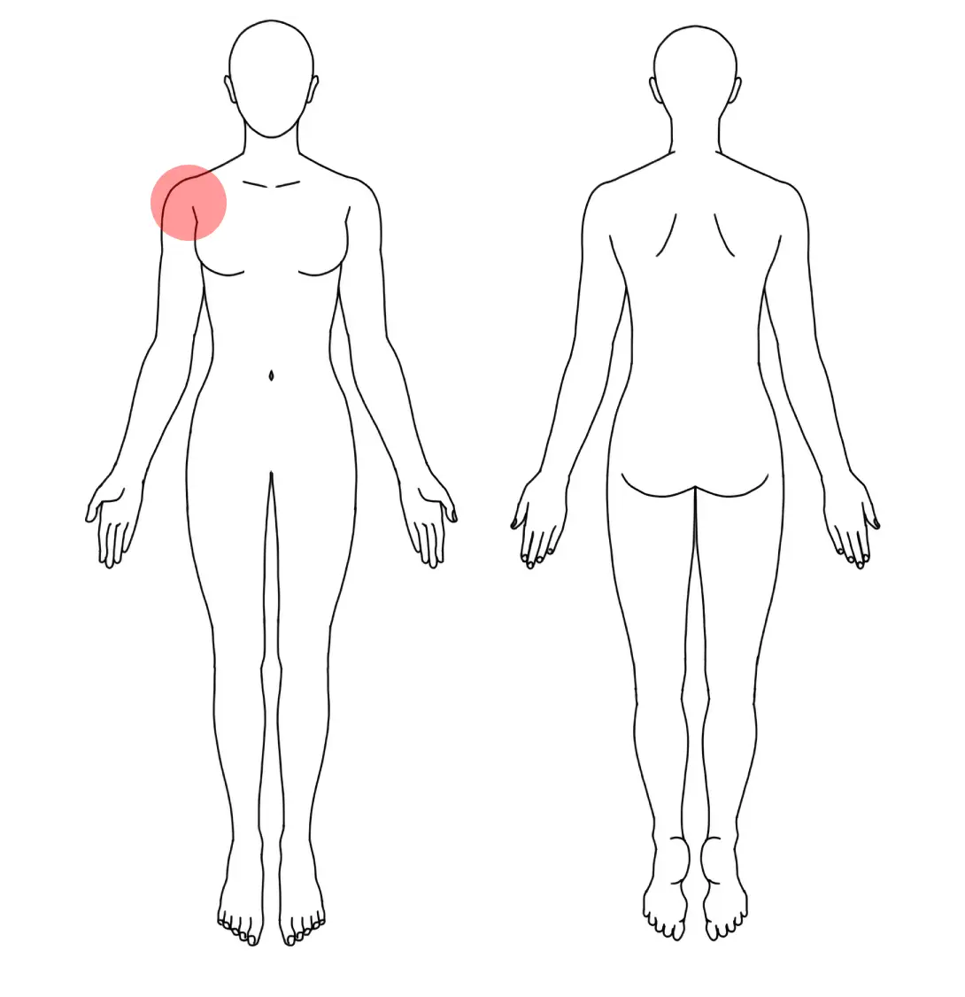 人体図（Ｔさんの右腕の五十肩）