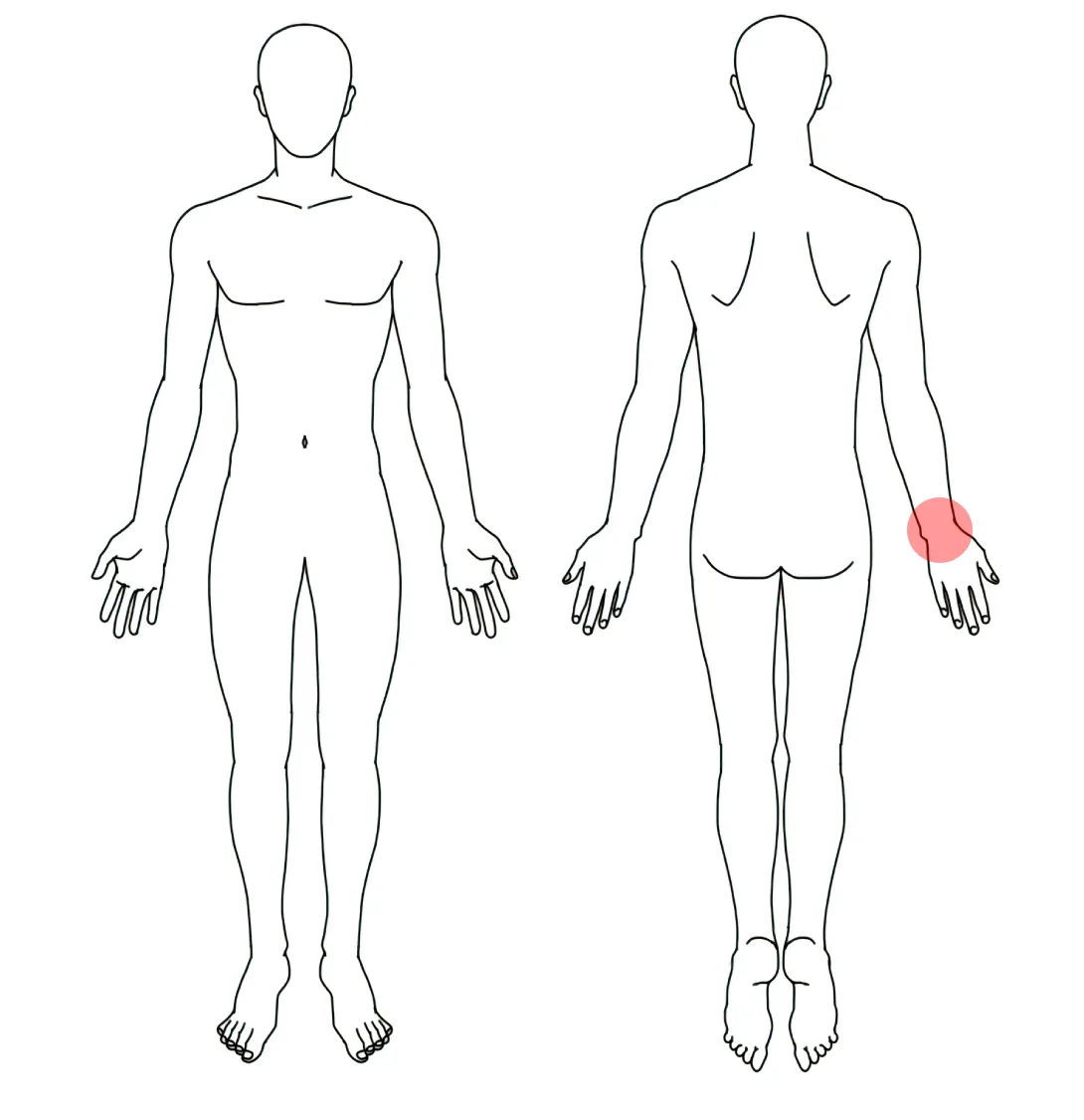 人体図（Ｎさんの右手首の腱鞘炎）