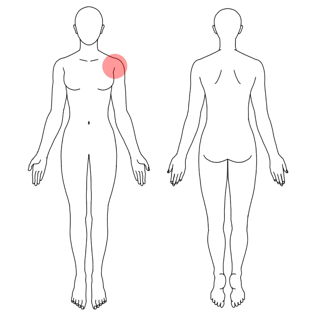 人体図（Ｔさんの左の五十肩）